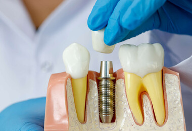 Имплантация зубов: что это такое и как это происходит?